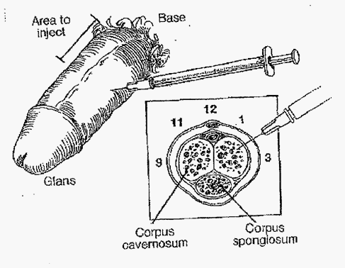 Why would a Trimix injection be needed?